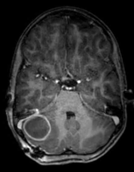 Cerebellar abscess (Radiopaedia 73727-84563 Axial T1 C+ fat sat 50).jpg