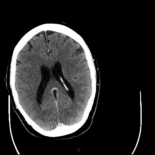 Cerebellar abscess (Radiopaedia 78135-90671 Axial C+ delayed 65).jpg