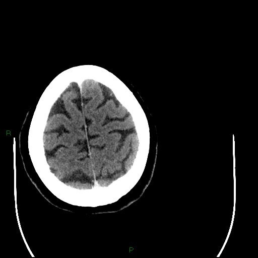 Cerebellar abscess (Radiopaedia 78135-90671 Axial C+ delayed 93).jpg