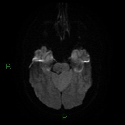 Cerebellar abscess (Radiopaedia 78135-90678 Axial DWI 11).jpg