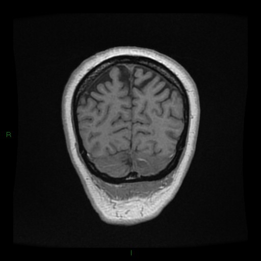 File:Cerebellar abscess (Radiopaedia 78135-90678 Coronal T1 C+ 143).jpg