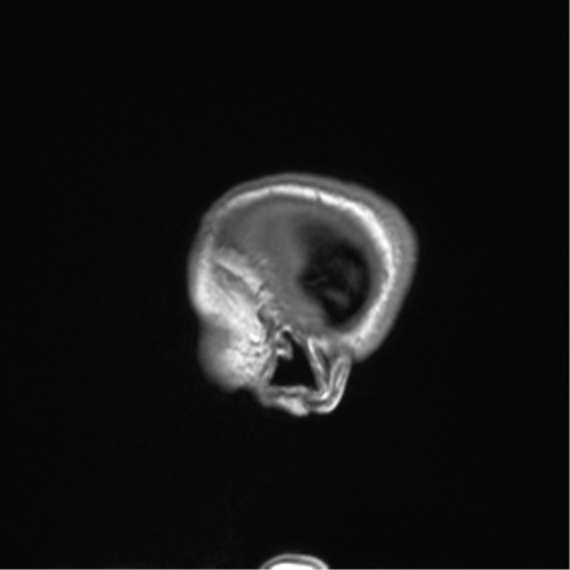 File:Cerebellar agenesis with hypoplastic pons (pontocerebellar hypoplasia) (Radiopaedia 57224-64138 Sagittal T1 60).png