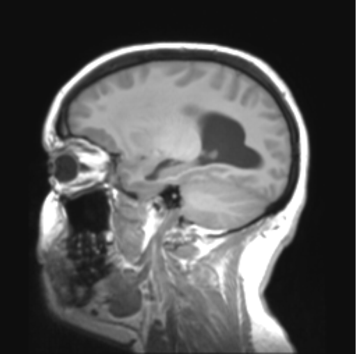 File:Cerebellar ependymoma complicated by post-operative subdural hematoma (Radiopaedia 83322-97736 Sagittal T1 14).png