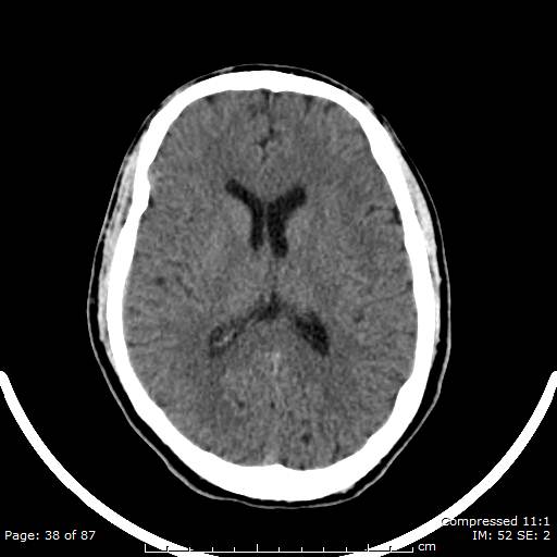 Cerebellar hemangioblastoma (Radiopaedia 52360-58258 Axial non-contrast 38).jpg