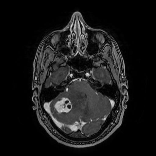 Cerebellar hemangioblastoma (Radiopaedia 88055-104622 Axial T1 C+ 59).jpg