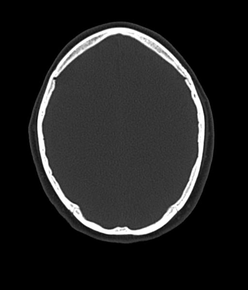 File:Cerebellar metastases - colorectal adenocarcinoma (Radiopaedia 40947-43652 AX Bone C- 2.0 MPR 44).png