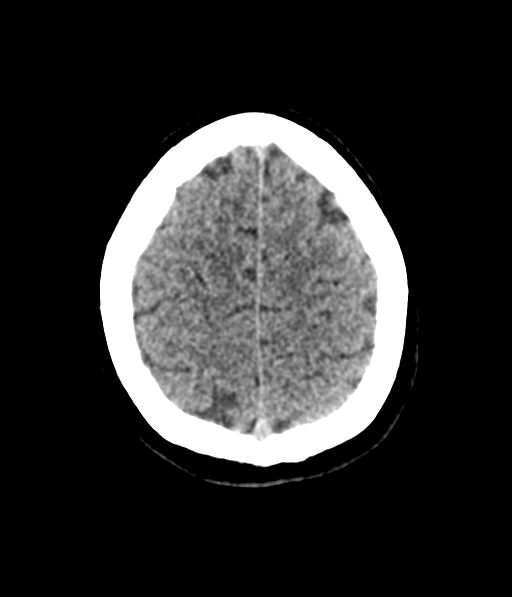 File:Cerebellar metastases - colorectal adenocarcinoma (Radiopaedia 40947-43652 Axial non-contrast 56).png