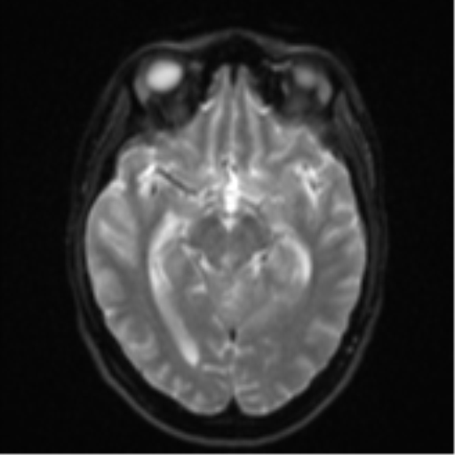 Cerebellar metastasis - adenocarcinoma lung (Radiopaedia 63184-71715 Axial DWI 13).png