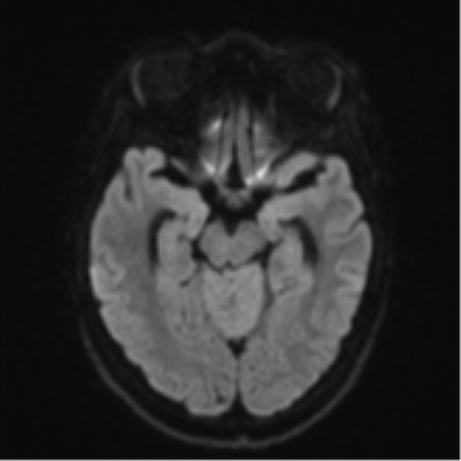 Cerebellar metastasis - adenocarcinoma lung (Radiopaedia 63184-71715 Axial DWI 40).png