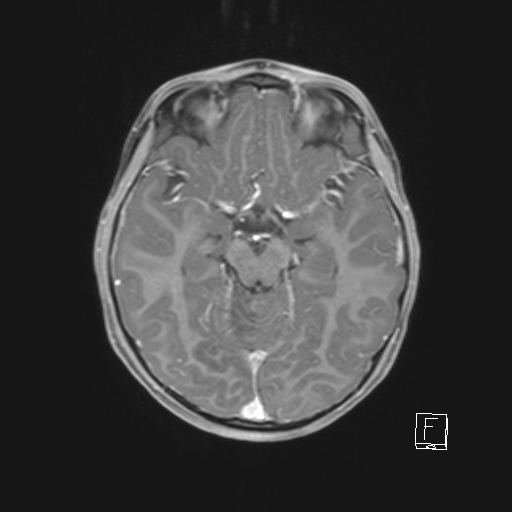 Cerebellar stroke (Radiopaedia 32202-33150 Axial T1 C+ 34).png