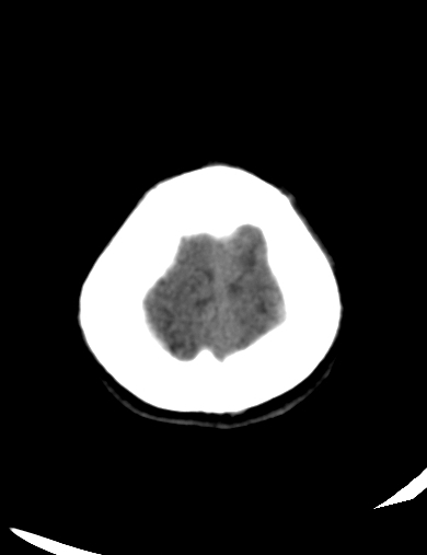 File:Cerebellitis (Radiopaedia 63148-71665 Axial non-contrast 3).jpg