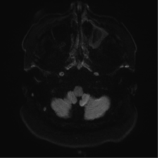 Cerebellopontine angle meningioma (Radiopaedia 48434-53348 Axial DWI 39).png