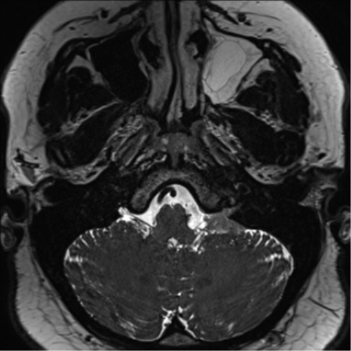 Cerebellopontine angle meningioma (Radiopaedia 48434-53348 Axial T2 Space 35).png