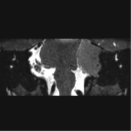 Cerebellopontine angle meningioma (Radiopaedia 48434-53348 Coronal T2 43).png