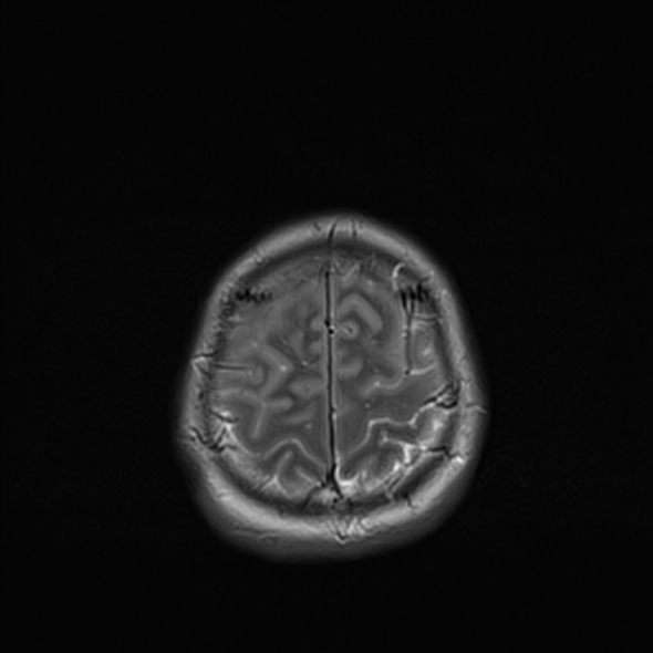 Cerebral abscess (Radiopaedia 24212-24478 Axial T2 52).jpg