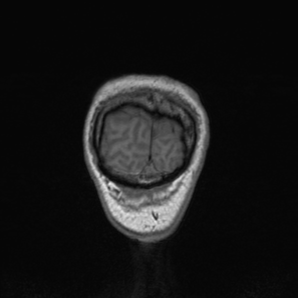 Cerebral abscess (Radiopaedia 24212-24478 Coronal T1 187).jpg
