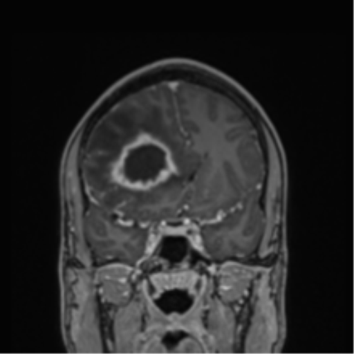Cerebral abscess (Radiopaedia 60342-68009 H 33).png