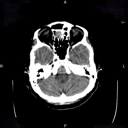 File:Cerebral abscess (Radiopaedia 7606-8431 Axial non-contrast 9).jpg