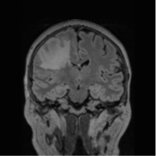 Cerebral abscess from pulmonary arteriovenous malformation (Radiopaedia 86275-102291 Coronal FLAIR 46).png