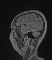 Cerebral abscess from pulmonary arteriovenous malformation (Radiopaedia 86275-102291 Sagittal FLAIR 16).png