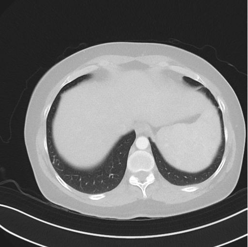 Cerebral abscess from pulmonary arteriovenous malformation (Radiopaedia 86275-102292 Axial lung window 49).png
