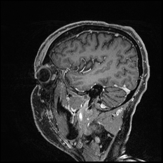 Cerebral abscess with ventriculitis (Radiopaedia 78965-91878 Sagittal T1 C+ 46).jpg
