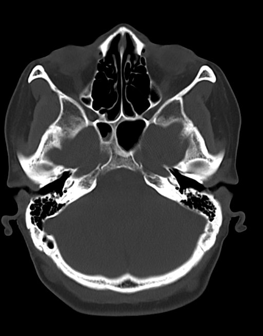 Cerebral abscesses (Radiopaedia 70458-80568 Axial bone window 17).jpg