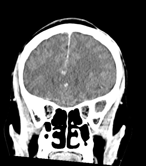Cerebral abscesses (Radiopaedia 70458-80568 Coronal Contrast 22).jpg