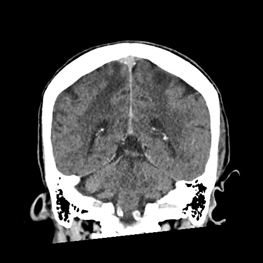 Cerebral amyloid angiopathy-related inflammation (Radiopaedia 74836-85848 Coronal non-contrast 47).jpg