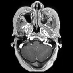 Cerebral amyloid angiopathy (Radiopaedia 29129-29518 Axial T1 C+ 31).jpg