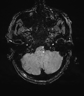 File:Cerebral amyloid angiopathy (Radiopaedia 46082-50433 Axial SWI 13).png
