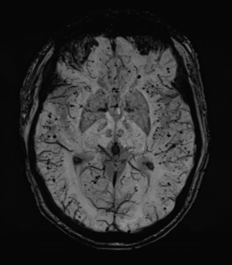 Cerebral amyloid angiopathy (Radiopaedia 46082-50433 Axial SWI MIP 37).png