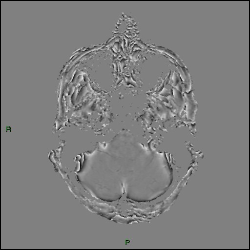 Cerebral amyloid angiopathy (Radiopaedia 77506-89664 H 21).jpg