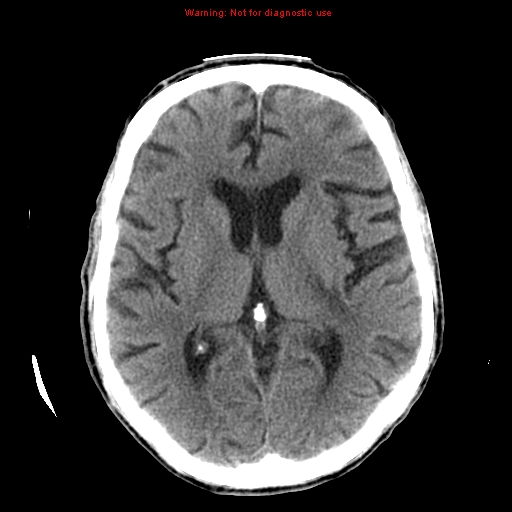File:Cerebral and orbital tuberculomas (Radiopaedia 13308-13310 Axial non-contrast 15).jpg