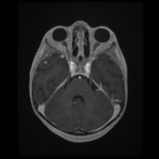 Cerebral and spinal tuberculosis (Radiopaedia 90489-107837 Axial T1 C+ 67).jpg