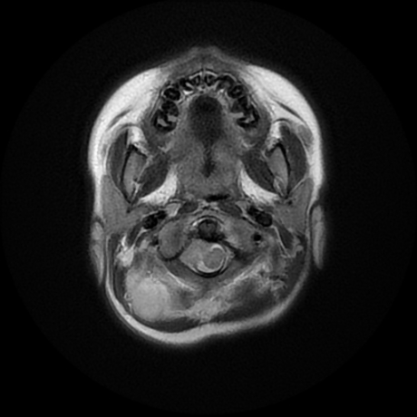 File:Cerebral and spinal tuberculosis (Radiopaedia 90489-107837 Axial T2 2).jpg