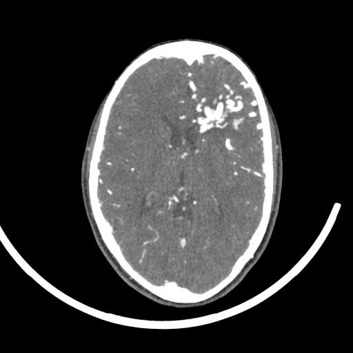 Cerebral arteriovenous malformation (Radiopaedia 29531-30031 E 14).jpg