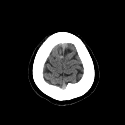 File:Cerebral arteriovenous malformation (Radiopaedia 39259-41505 Brain Ax 5mm 26).png