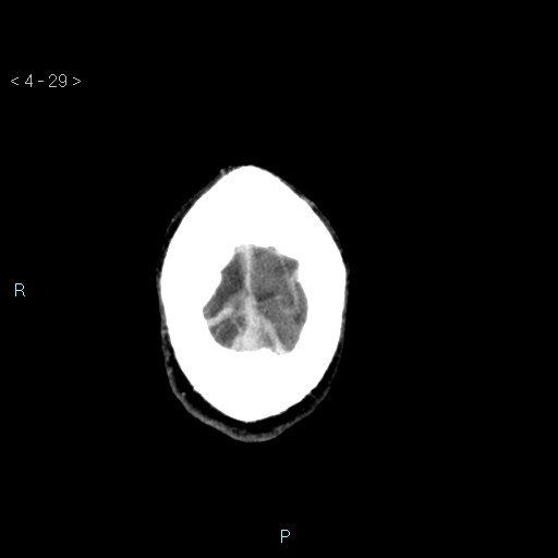 File:Cerebral arteriovenous malformation (Radiopaedia 40528-43125 Axial C+ delayed 29).jpg