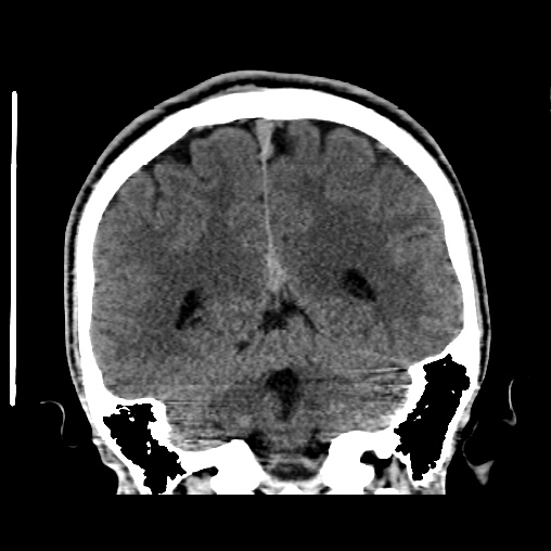 File:Cerebral arteriovenous malformation (Radiopaedia 61964-70028 Coronal non-contrast 42).jpg
