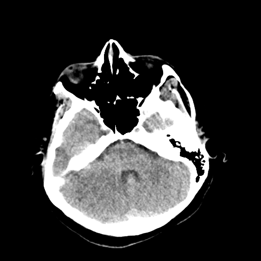 File:Cerebral arteriovenous malformation (Radiopaedia 73830-84645 Axial non-contrast 12).jpg