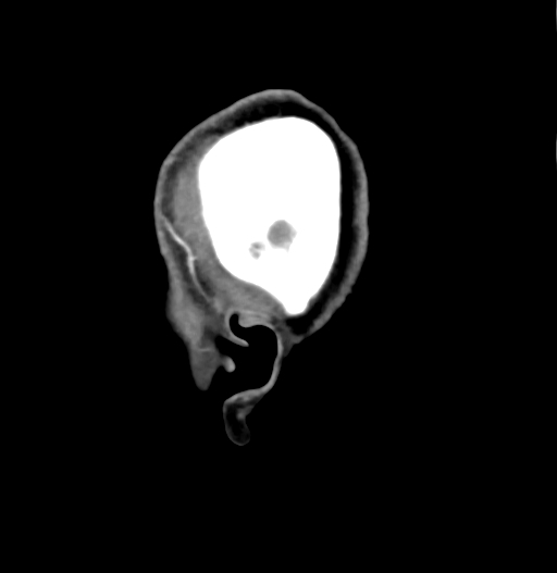 Cerebral arteriovenous malformation (Radiopaedia 73830-84645 D 4).jpg