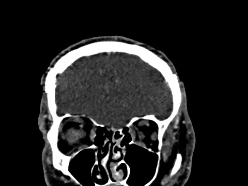 File:Cerebral arteriovenous malformation (Radiopaedia 78188-90746 Coronal C+ delayed 17).jpg
