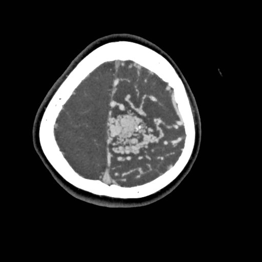 File:Cerebral arteriovenous malformation (Radiopaedia 79677-92888 A 50).jpg