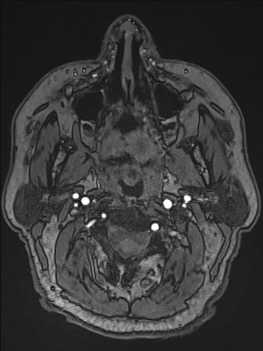 Cerebral arteriovenous malformation (Radiopaedia 84015-99245 Axial TOF 3).jpg