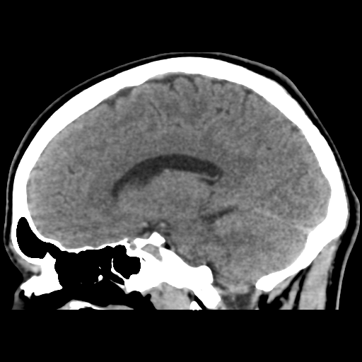 Cerebral arteriovenous malformation (Spetzler-Martin grade 2) (Radiopaedia 41262-44076 A 36).png
