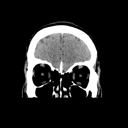 Cerebral arteriovenous malformation (Spetzler-Martin grade 2) (Radiopaedia 41262-44076 Coronal non-contrast 11).png