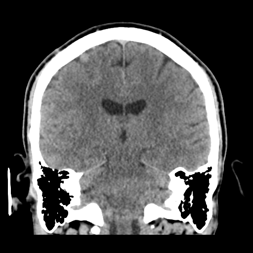 Cerebral arteriovenous malformation (Spetzler-Martin grade 2) (Radiopaedia 41262-44076 Coronal non-contrast 37).png