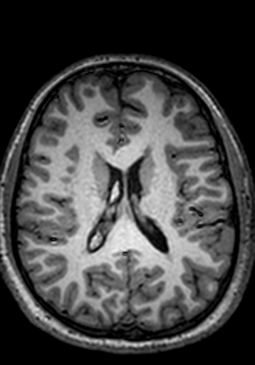 Cerebral arteriovenous malformation at posterior body of corpus callosum (Radiopaedia 74111-84925 Axial T1 115).jpg