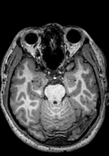 Cerebral arteriovenous malformation at posterior body of corpus callosum (Radiopaedia 74111-84925 Axial T1 204).jpg